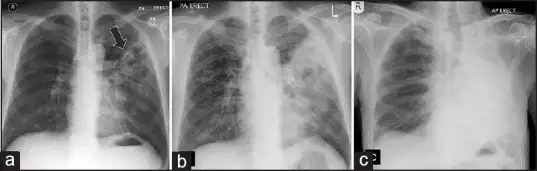 类鼻疽肺部影像学表现
