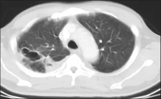 类鼻疽引起的肺部空洞
