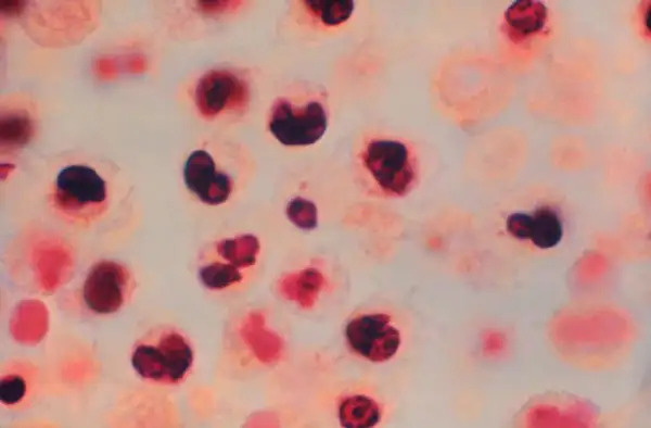 军团菌感染的肺部病理显微照片，显示肺泡内充满巨噬细胞和多形核白细胞