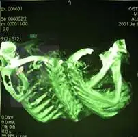 X光片显示杀死奥茨的箭头位置