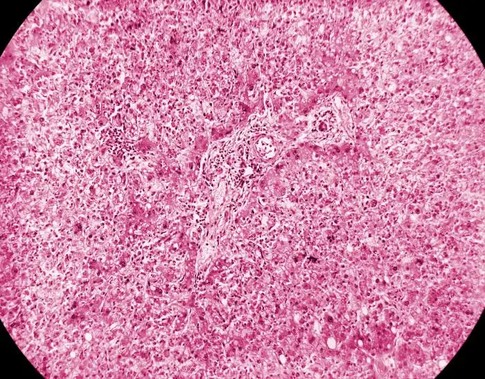 黄热病肝脏病理切片显示中区坏死和脂肪变性