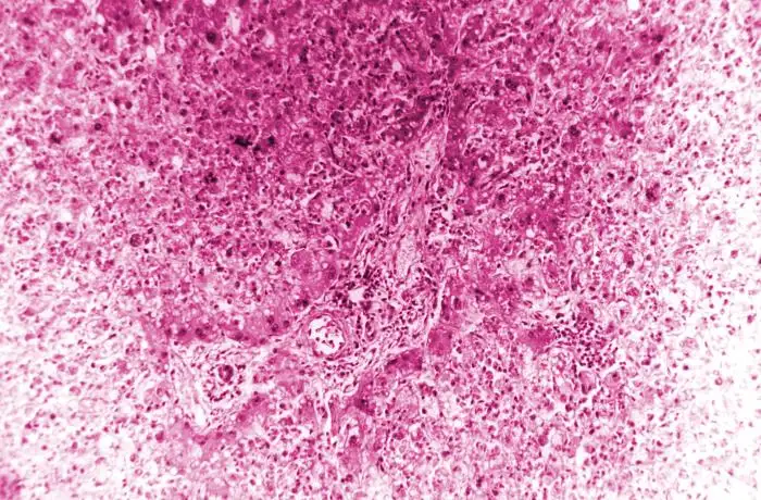 黄热病肝脏病理切片显示典型的中区肝细胞坏死