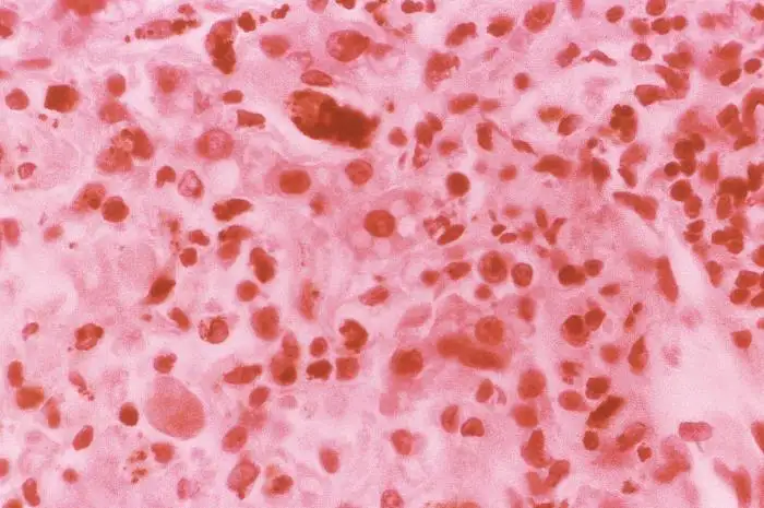 黄热病相关病理图像