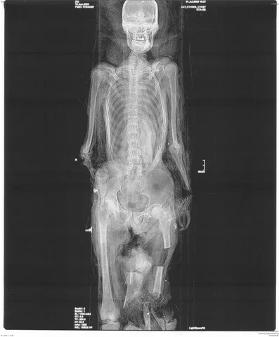 X光片显示截断的四肢