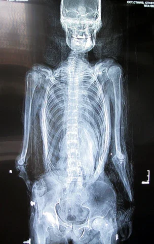 X光片显示损伤细节