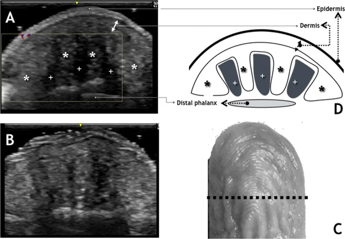 手指末端超声图像：起皱前后的组织变化