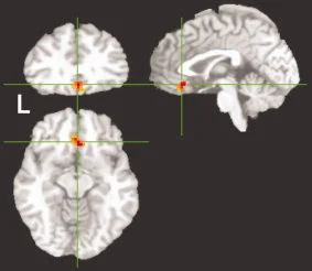 哈欠传染与额叶的fMRI研究